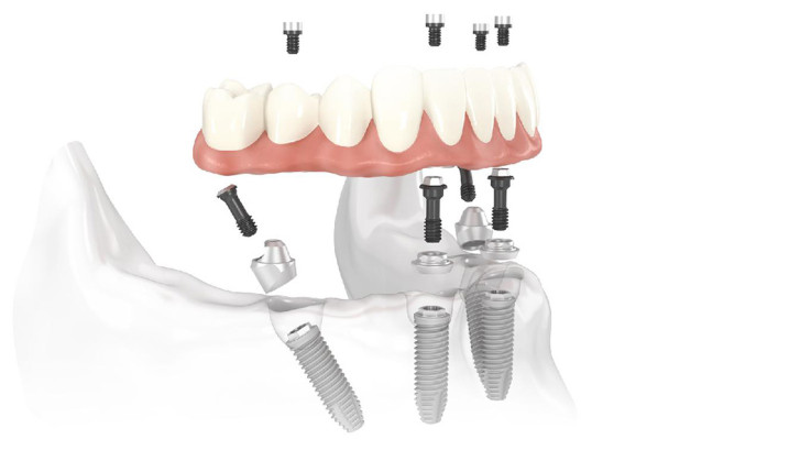 Costo impianti dentali